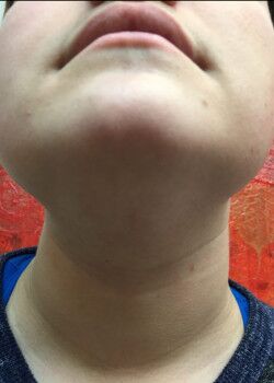 After Image: Male Facial Hair Removal Case ID: 1221 - front
