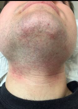Before Image: Male Facial Hair Removal Case ID: 1221 - front