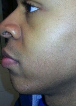 After Image: Male Facial Hair Removal Case ID: 0596 - front