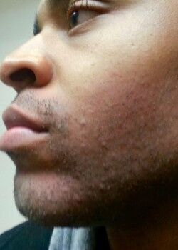 Before Image: Male Facial Hair Removal Case ID: 0596 - front