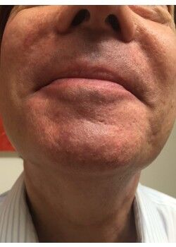 After Image: Male Facial Hair Removal Case ID: 0609 - front