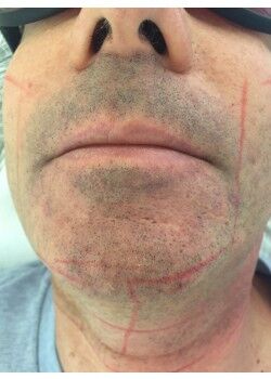Before Image: Male Facial Hair Removal Case ID: 0609 - front